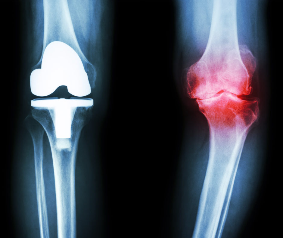 artrosi protesi ginocchio